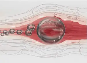 bolla embolia sangue